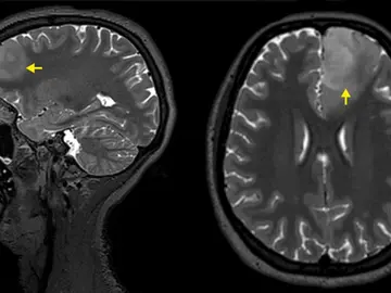 Imagen de resonancia magnética de un tumor cerebral Imagen de resonancia magnética de un tumor cerebral