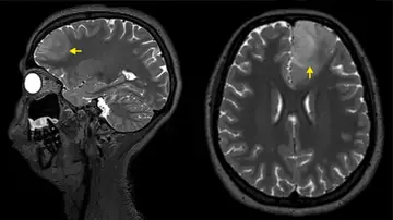 Imagen de resonancia magnética de un tumor cerebral Imagen de resonancia magnética de un tumor cerebral