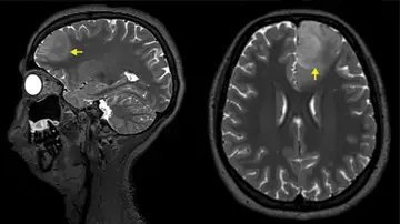Imagen de resonancia magnética de un tumor cerebral Imagen de resonancia magnética de un tumor cerebral