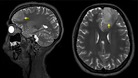 Imagen de resonancia magnética de un tumor cerebral Imagen de resonancia magnética de un tumor cerebral