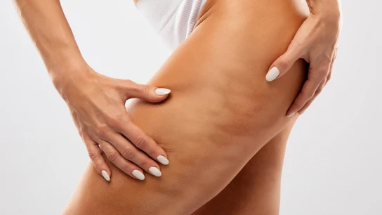 Celulitis Celulitis