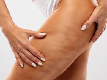 Celulitis