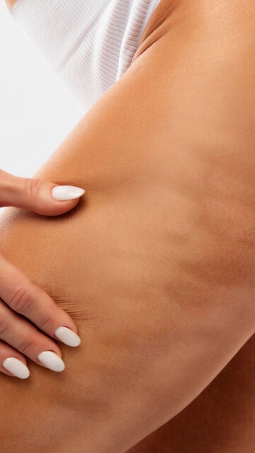 Celulitis
