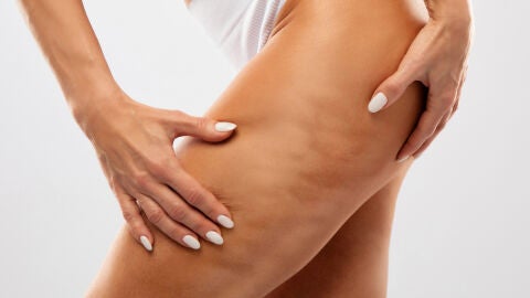 Celulitis