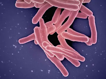 Los casos de tuberculosis infantil aumentan un 26 en la Union Europea Los casos de tuberculosis infantil aumentan un 26 en la Union Europea