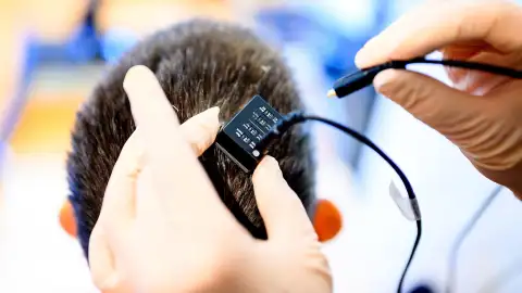 Implante cerebral Implante cerebral