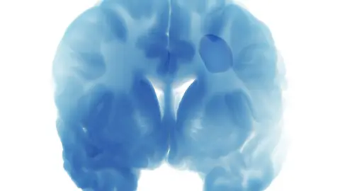 Accidente cerebrovascular Accidente cerebrovascular