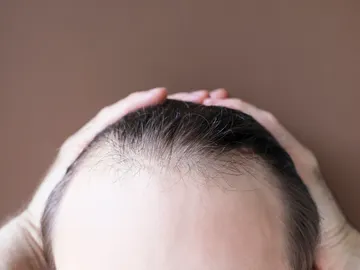 Caída de pelo Caída de pelo
