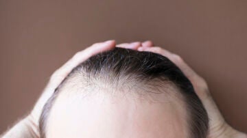 Caída de pelo