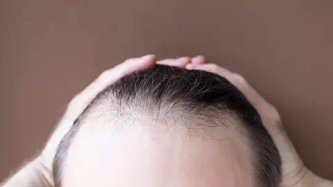 Caída de pelo Caída de pelo