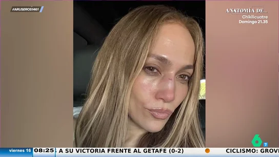 El corte en la nariz de Jennifer Lopez mientras ensayaba para los Premios AMMAS El corte en la nariz de Jennifer Lopez mientras ensayaba para los Premios AMMAS