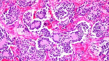 Neuroblastoma
