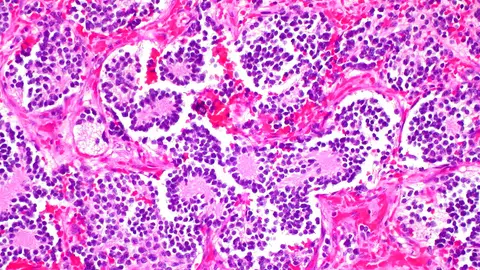 Neuroblastoma Neuroblastoma