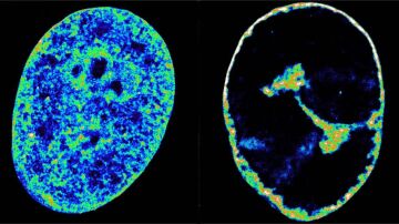 Células humanas antes y después de la infección por el herpes labial