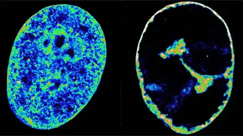 Células humanas antes y después de la infección por el herpes labial Células humanas antes y después de la infección por el herpes labial