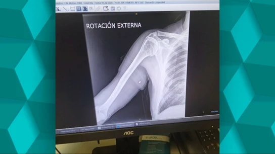 Albañil herido Albañil herido