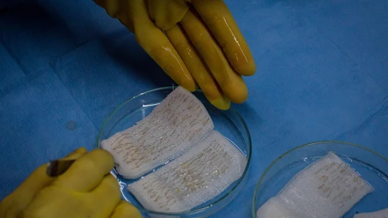Varios mechones de pelo antes de un procedimiento capilar en una clínica de Turquía Varios mechones de pelo antes de un procedimiento capilar en una clínica de Turquía