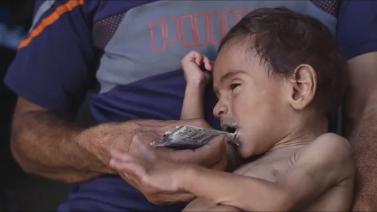 Miles de niños sufren problemas de desnutrición graves en Gaza. Miles de niños sufren problemas de desnutrición graves en Gaza.