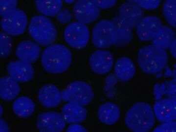 C&eacute;lulas de linfoma