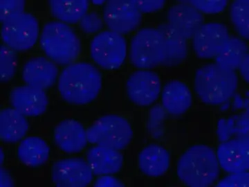 Células de linfoma Células de linfoma