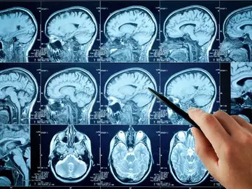 Imágenes de resonancia magnética cerebral Imágenes de resonancia magnética cerebral