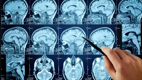 Imágenes de resonancia magnética cerebral Imágenes de resonancia magnética cerebral