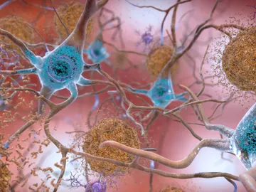 Alzheimer Alzheimer