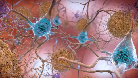 Descubren una relación entre la obesidad y el Alzheimer Descubren una relación entre la obesidad y el Alzheimer
