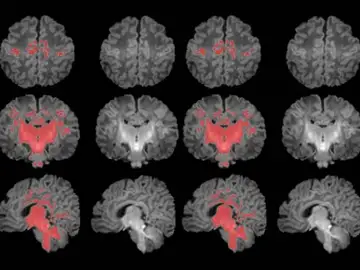 Resonancia magnética cerebral Resonancia magnética cerebral
