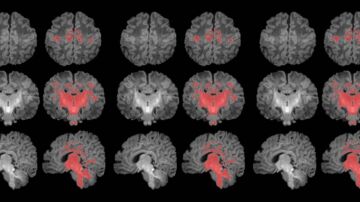 Resonancia magnética cerebral