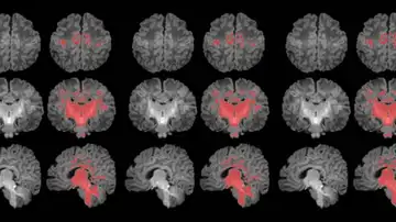 Resonancia magnética cerebral Resonancia magnética cerebral