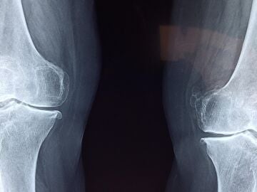 Descubren un interruptor maestro del envejecimiento: activarlo regenera los cart&iacute;lagos de las articulaciones