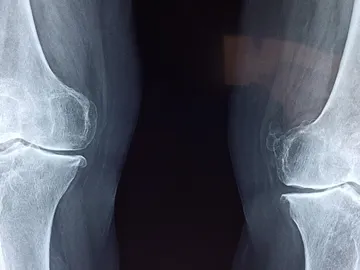 Descubren un interruptor maestro del envejecimiento: activarlo regenera los cartílagos de las articulaciones Descubren un interruptor maestro del envejecimiento: activarlo regenera los cartílagos de las articulaciones