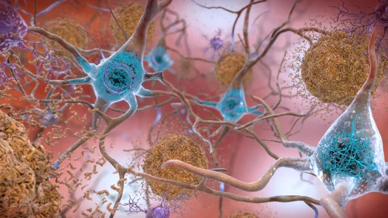 Alzheimer Alzheimer