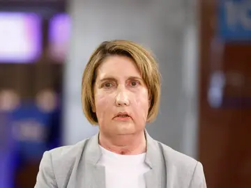 Carme, la primera paciente en recibir un trasplante de cara de una donante que recibió una eutanasia Carme, la primera paciente en recibir un trasplante de cara de una donante que recibió una eutanasia