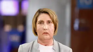 Carme, la primera paciente en recibir un trasplante de cara de una donante que recibió una eutanasia Carme, la primera paciente en recibir un trasplante de cara de una donante que recibió una eutanasia