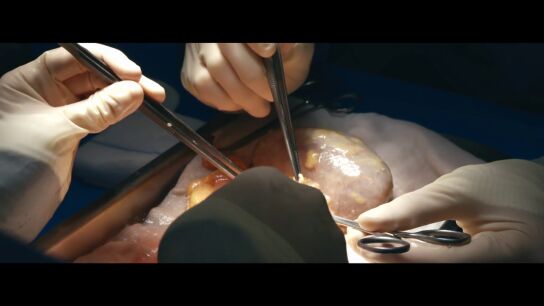 El momento en el que en plena operaci&oacute;n confirman que el h&iacute;gado es v&aacute;lido para donar: "Una persona puede salvar su vida"