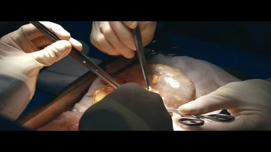 El momento en el que en plena operación confirman que el hígado es válido para donar: "Una persona puede salvar su vida" El momento en el que en plena operación confirman que el hígado es válido para donar: "Una persona puede salvar su vida"