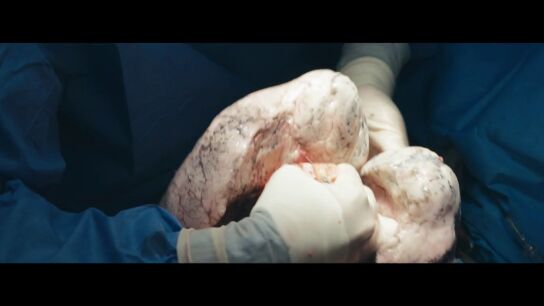 El impactante momento en el que sacan los pulmones de una persona fallecida para valorarlos como trasplante