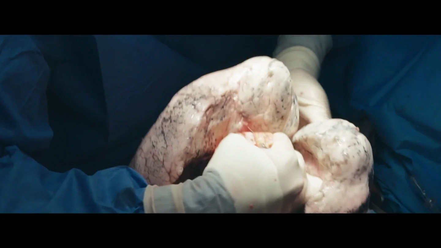 El impactante momento en el que sacan los pulmones de una persona fallecida para valorarlos como trasplante El impactante momento en el que sacan los pulmones de una persona fallecida para valorarlos como trasplante