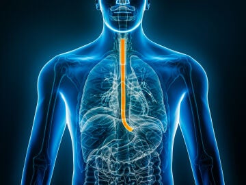 C&aacute;ncer de es&oacute;fago