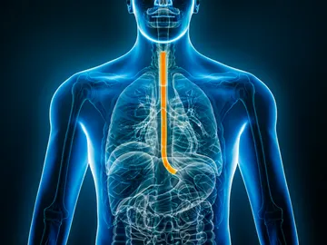 Cáncer de esófago Cáncer de esófago