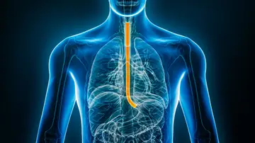 Cáncer de esófago Cáncer de esófago
