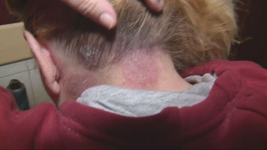 Inmaculada, paciente de dermatolog&iacute;a