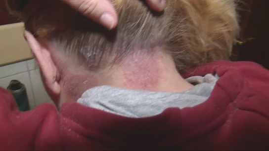 Inmaculada, paciente de dermatología Inmaculada, paciente de dermatología