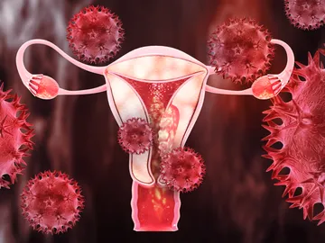 Cáncer de útero Cáncer de útero