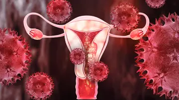 Cáncer de útero Cáncer de útero