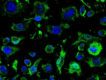 Imagen de agregados de TDP-43 (verde) fuera de los núcleos (azul) en los linfocitos de pacientes de ELA Imagen de agregados de TDP-43 (verde) fuera de los núcleos (azul) en los linfocitos de pacientes de ELA