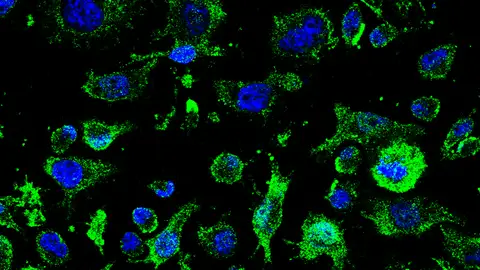 Imagen de agregados de TDP-43 (verde) fuera de los núcleos (azul) en los linfocitos de pacientes de ELA Imagen de agregados de TDP-43 (verde) fuera de los núcleos (azul) en los linfocitos de pacientes de ELA