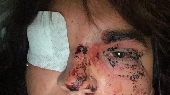 Bianca enseña las heridas que sufrió tras ser agredida por cinco mujeres Bianca enseña las heridas que sufrió tras ser agredida por cinco mujeres